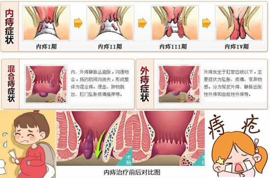 痔核脱出治疗最新进展及策略概述